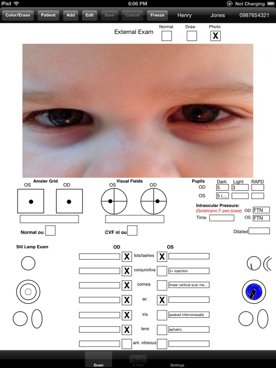 OphthyChart