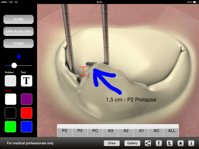 Mitral  Tricuspid Valves