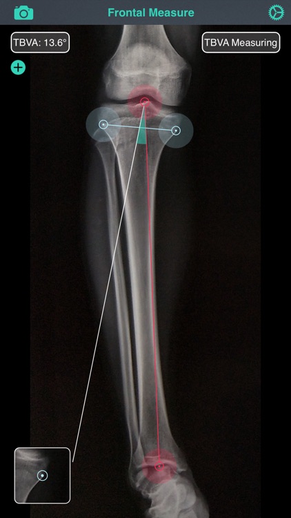 OsteoGauge - lower limb screenshot-4