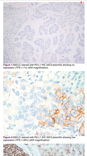 IASLC Atlas of PD-L1 Testing in Lung Cancer(圖3)-速報App