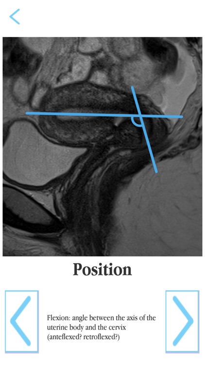 Female pelvis MRI RSNA screenshot-3