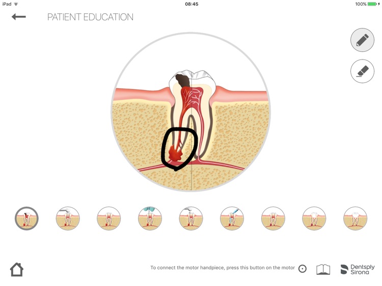 DENTSPLY ENDO IQ™ screenshot-4
