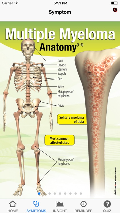 Signs & Symptoms Multiple Myeloma