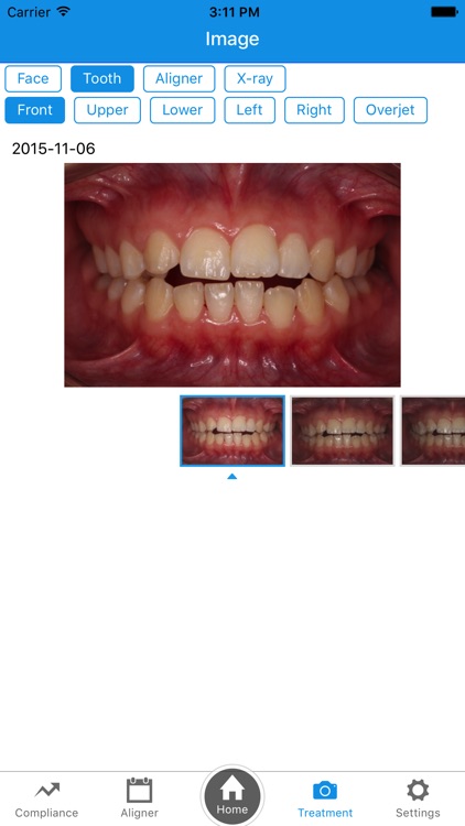 OrthoComm Aligner Management