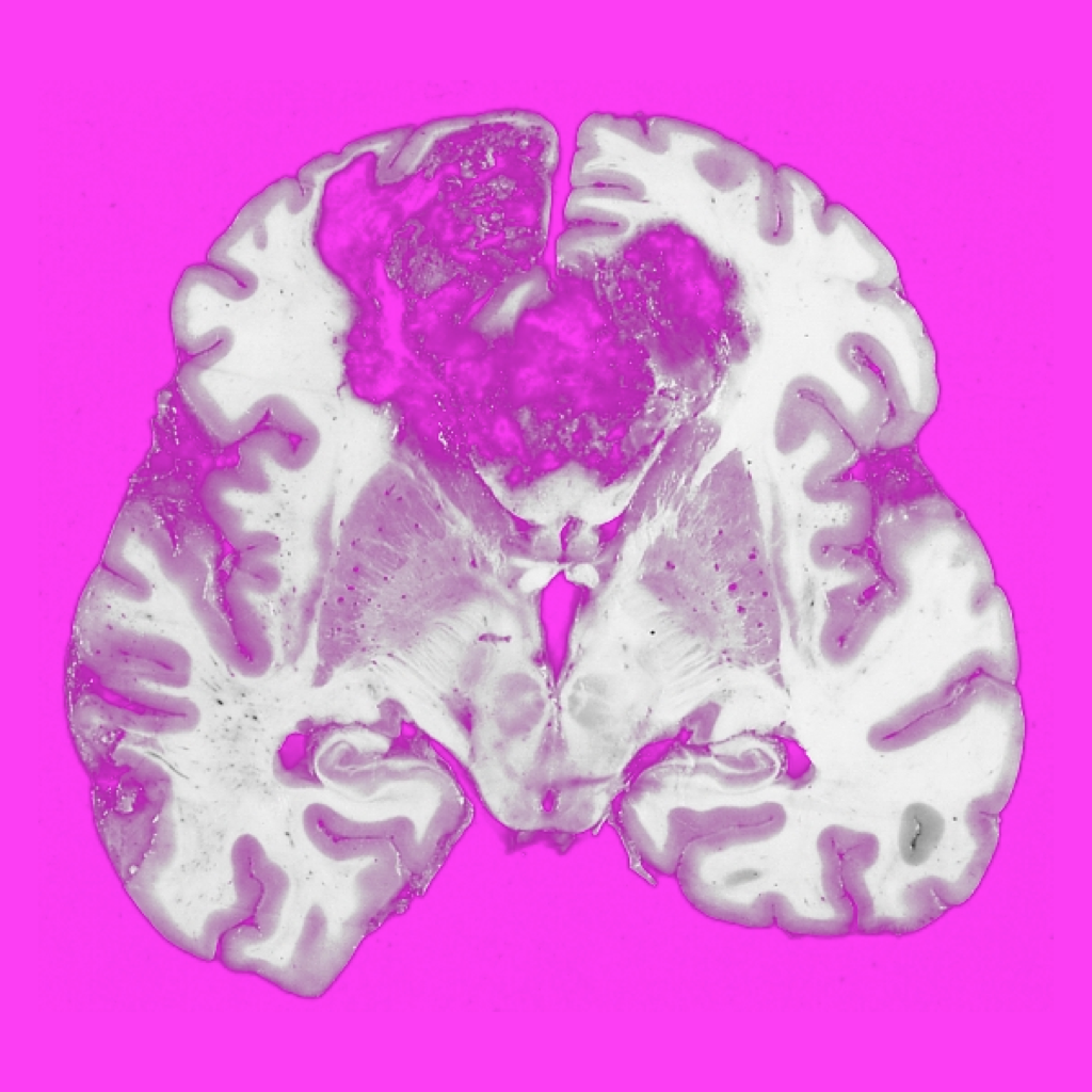 Neuro-oncology: WTD App Icon