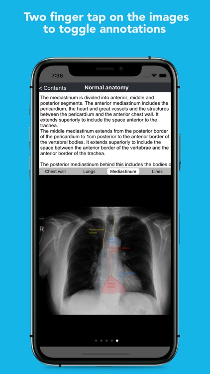 iCXR - Chest xray manual screenshot-3