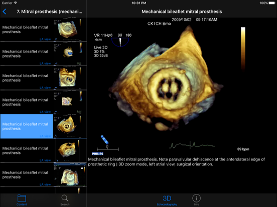 Screenshot #6 pour CARDIO3®3D Echocardiography HD