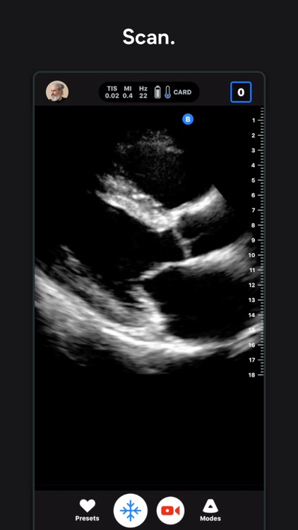 Butterfly iQ — Ultrasound