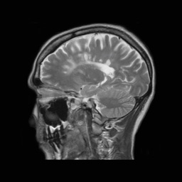 Understanding MRI: MS