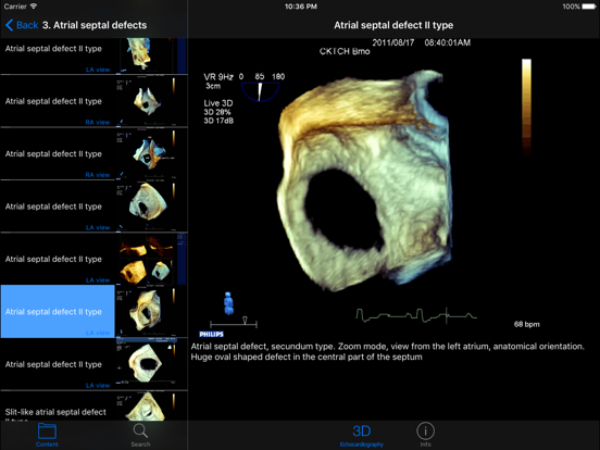 CARDIO3®3D Echocardiography HDのおすすめ画像5