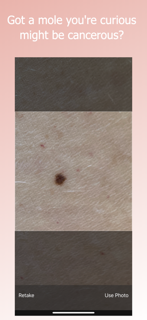 Skin Cancer Detector(圖2)-速報App