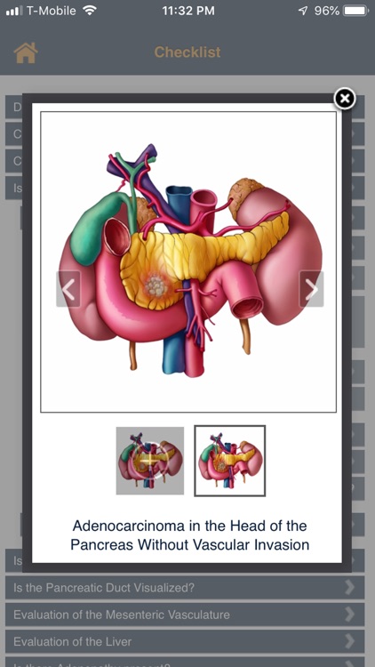 CTisus Pancreas Mass Checklist
