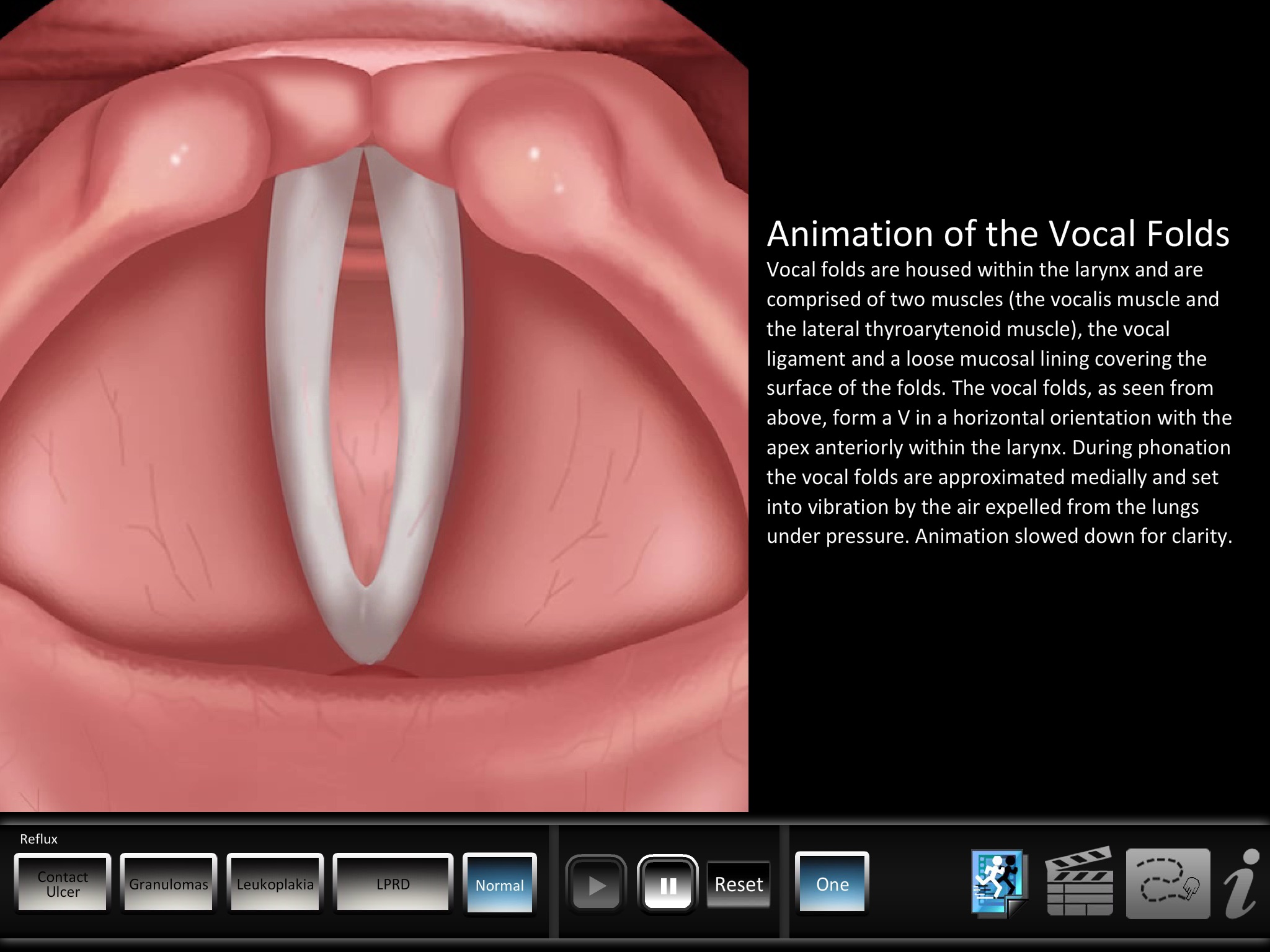 Vocal Pathology: Reflux screenshot 3