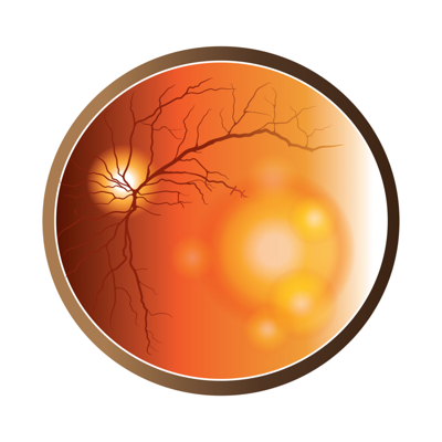 AMD & Anti-VEGF Therapy