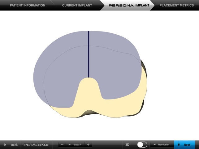 Persona® TKA Tibial Placement(圖4)-速報App