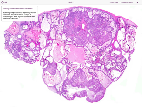 Ovarian Tumor Pathology screenshot 3