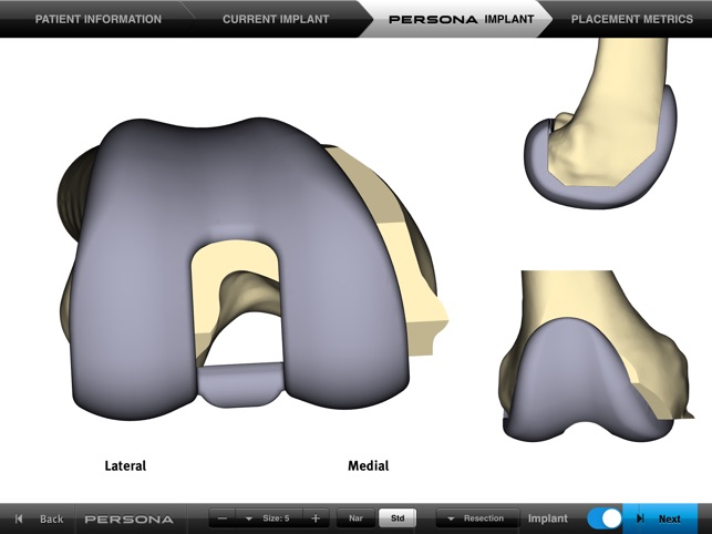 Persona® TKA Femoral Sizing(圖1)-速報App