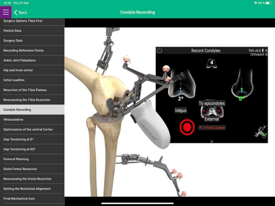 Screenshot #6 pour AESCULAP® OrthoPilot® Elite
