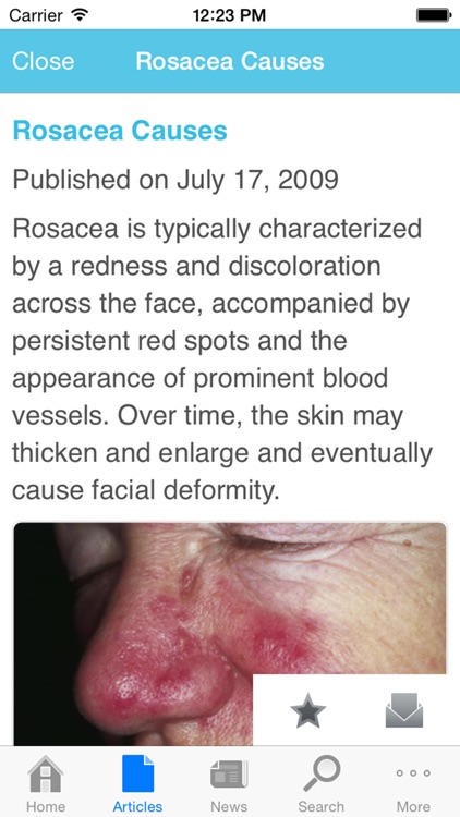 Rosacea by AZoMedical