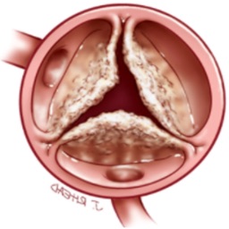 Aortic Stenosis