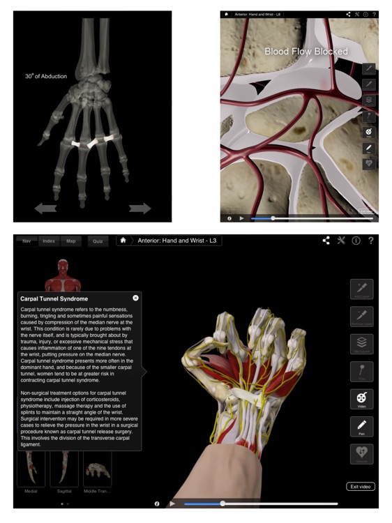 Hand & Wrist Pro III for iPad