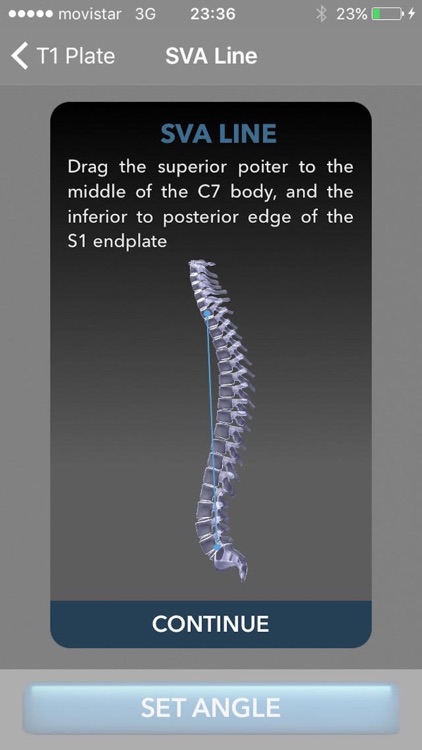 Sagittal Balance Advance