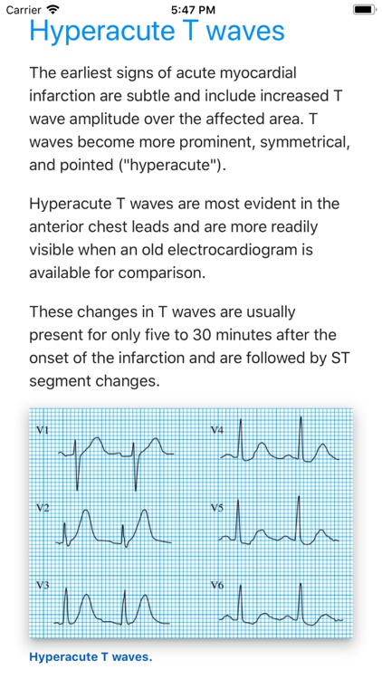 ECG Basics Pro - ECG Made Easy