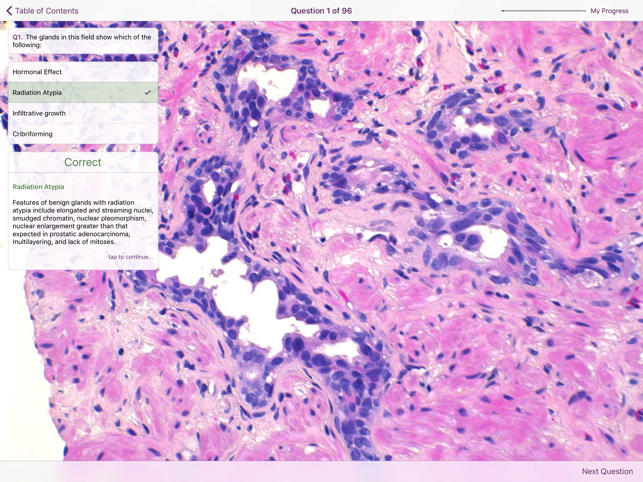 Hopkins Prostate Pathology(圖5)-速報App