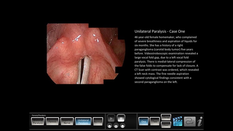 Paresis/Paralysis