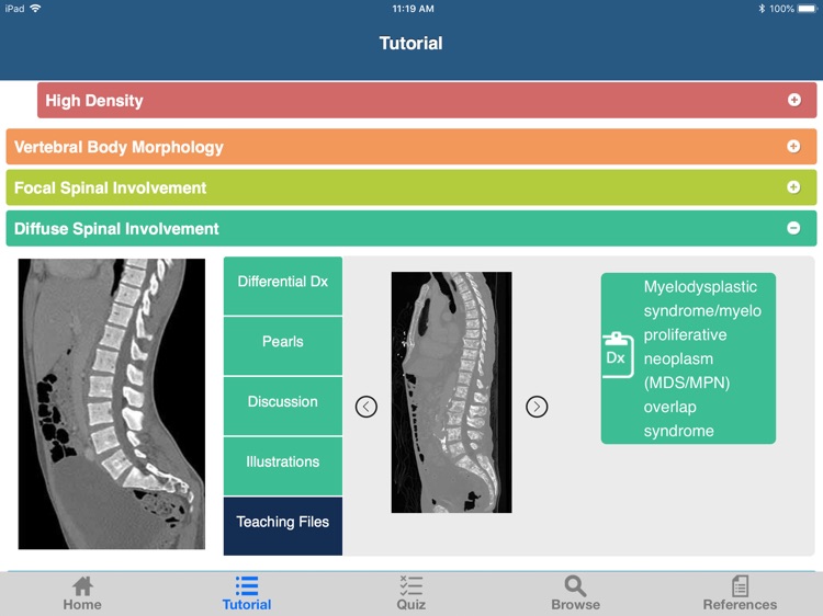 CTisus L-Spine Pathology screenshot-4