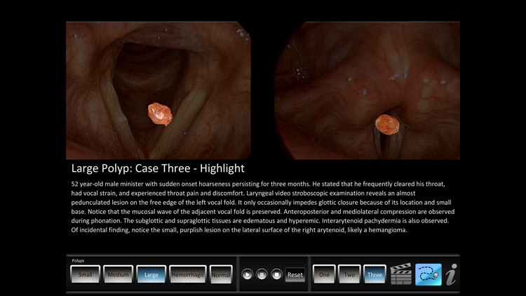 Vocal Pathology: Polyps