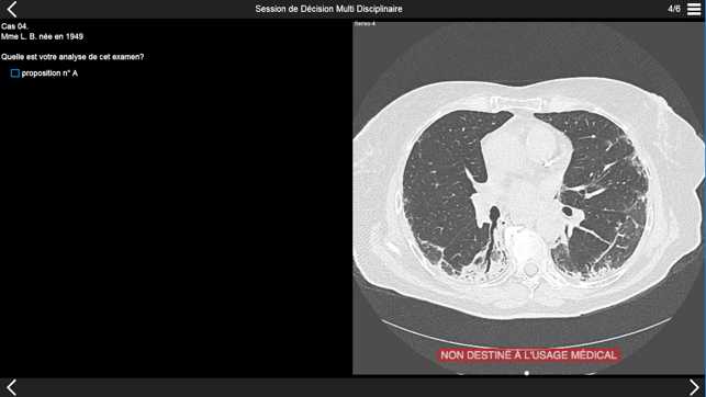 Fibrose pulmonaire 2017(圖2)-速報App