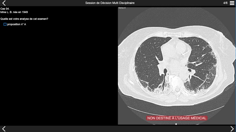 Fibrose pulmonaire 2017