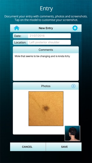 ApreSkin you - track your moles, skin cancers / melanoma and(圖2)-速報App