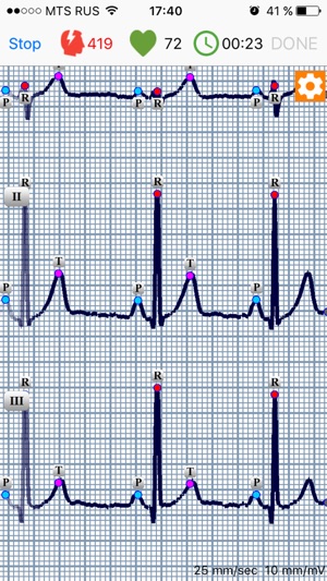 ECG Dongle(圖2)-速報App