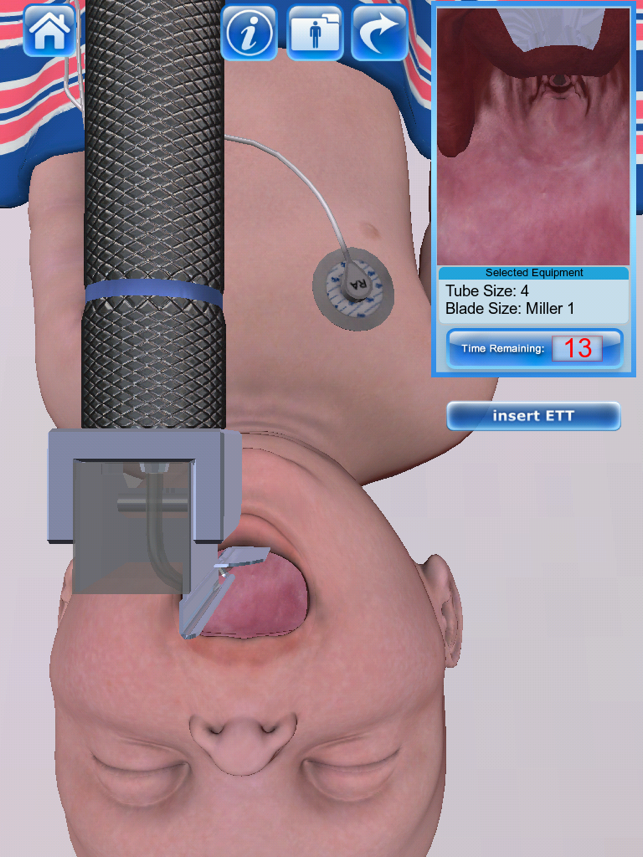 Infant Endotracheal Intubation(圖4)-速報App