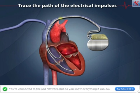 ArchieMD IC Health: Cardiac Pacemaker screenshot 4