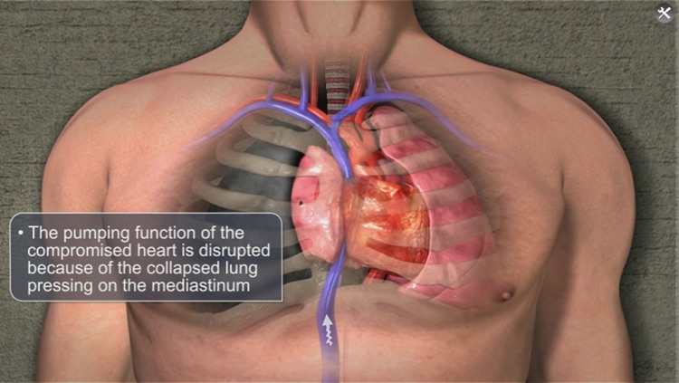 Medrills: NCD for Pneumothorax