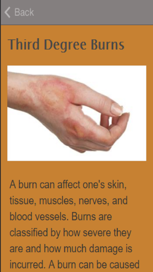 How To Treat Burns(圖3)-速報App