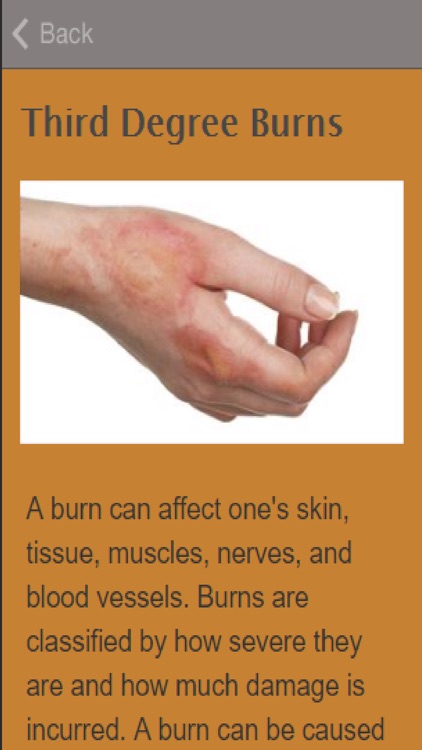 How To Treat Burns