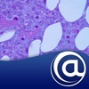 Multiple Myeloma [MM]