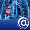 Non-Small Cell Lung Cancer