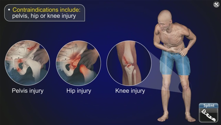 Medrills: Fracture