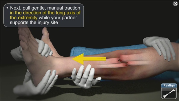 Medrills: Fracture