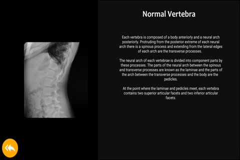 Skeletal Dysplasia Viewer: Spine screenshot 4