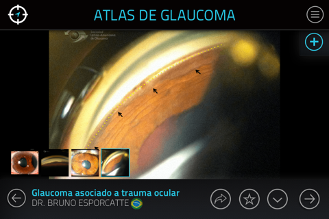 Atlas de Glaucoma para iPhone screenshot 4