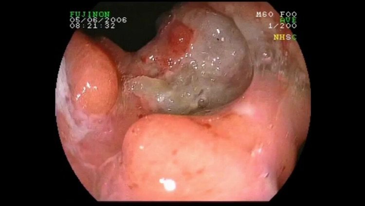 ENDO3® Atlas of Gastrointestinal Endoscopy screenshot-4