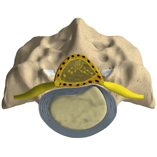 mLumbarDiscHerniation