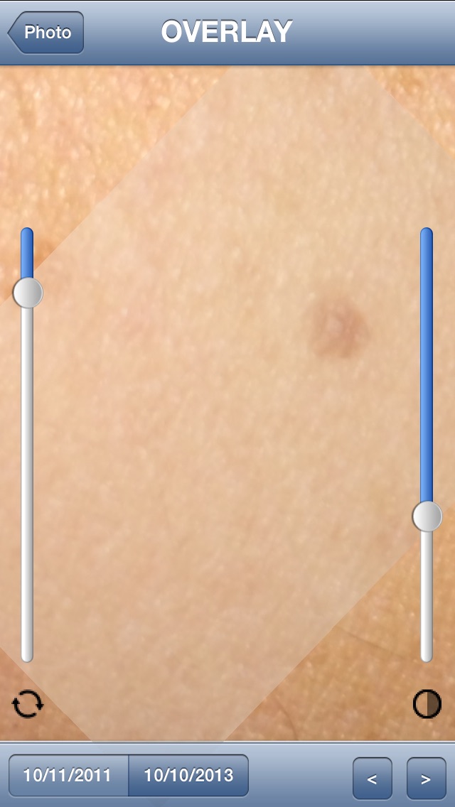 Skin Prevention – Photo Body Map for Melanoma and Skin Cancer early detection Screenshot 5