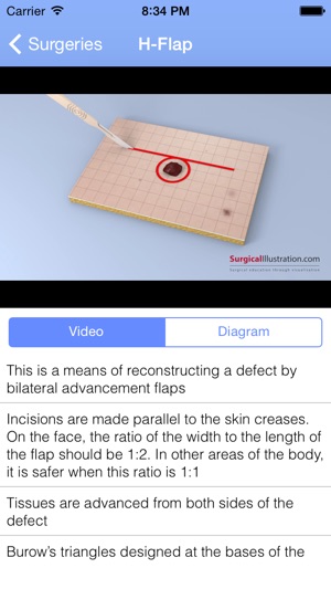 Surgical Flaps(圖3)-速報App